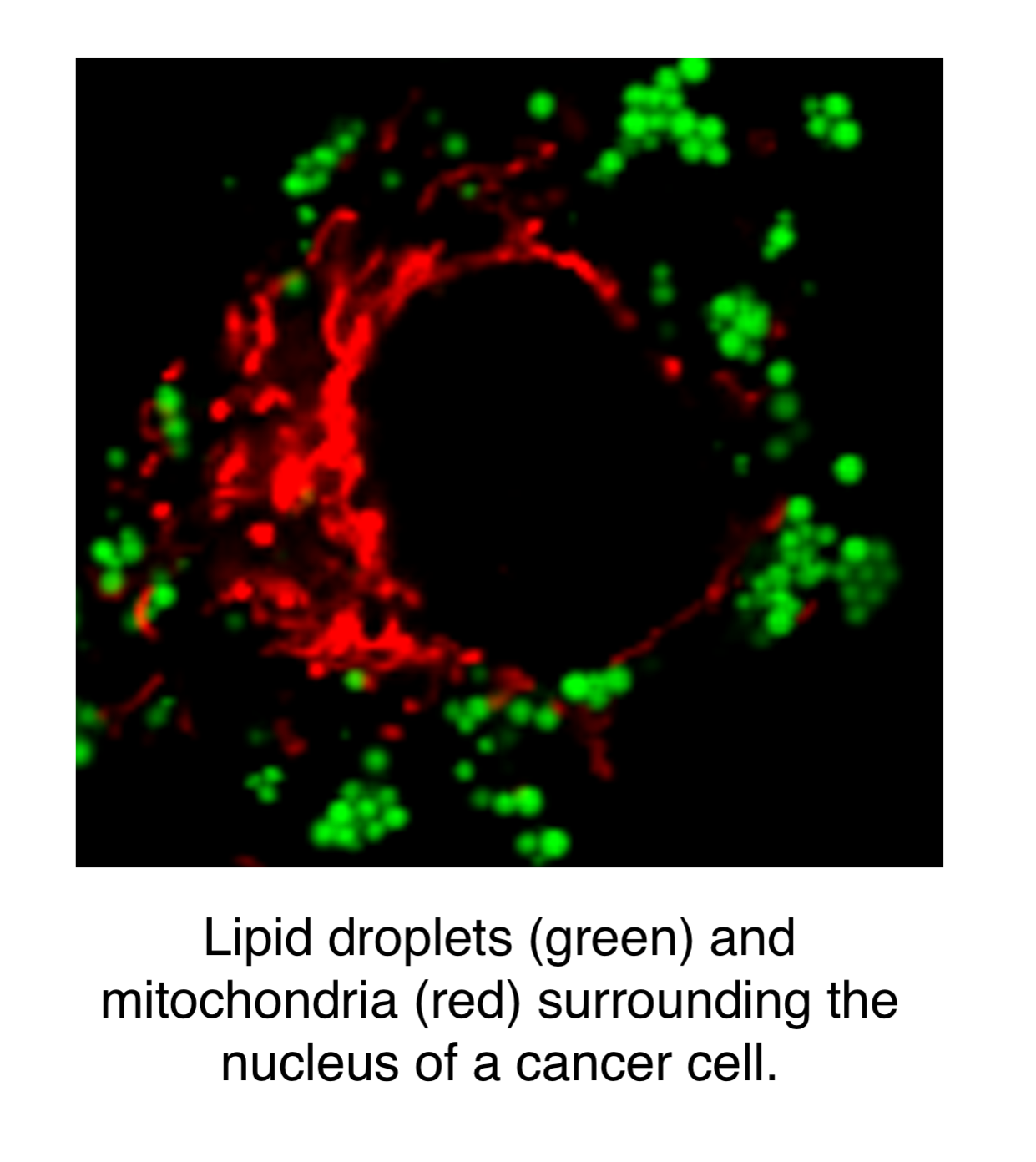 sPLA2-induced cancer cell